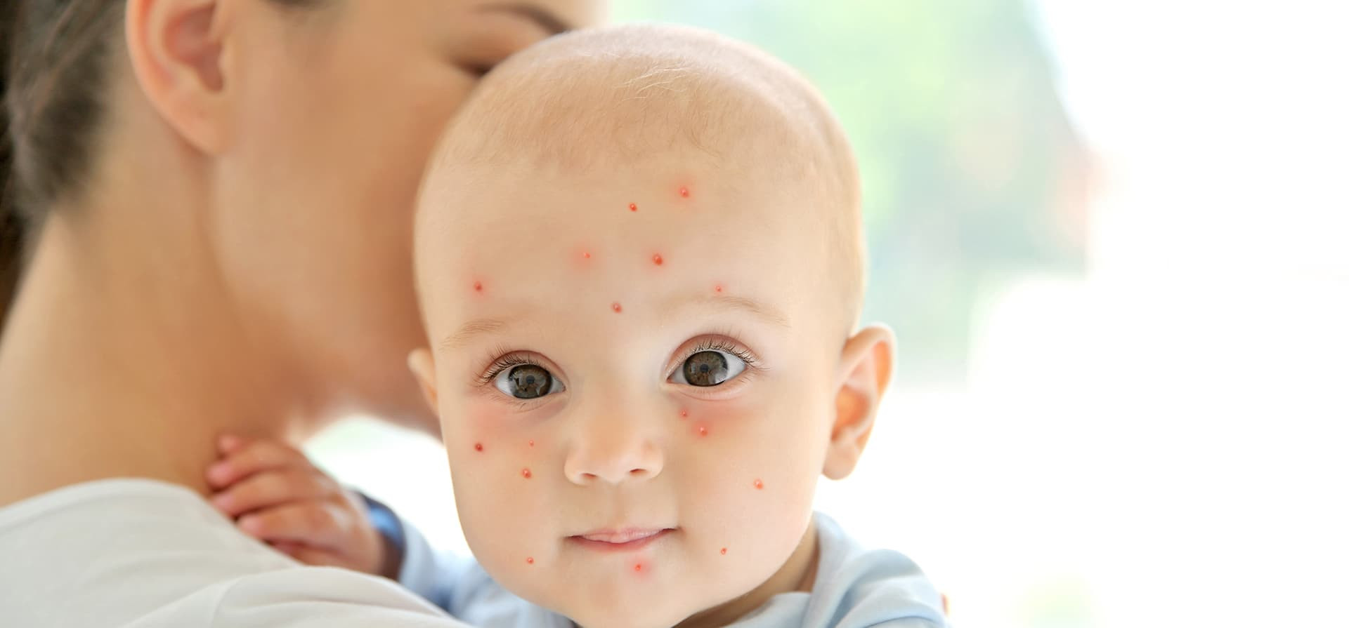 Tout ce qu’il faut savoir sur la varicelle de bébé